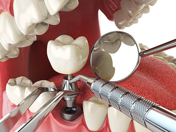 Best Emergency Treatment for Dental Infections or Abscesses in Mack, OH